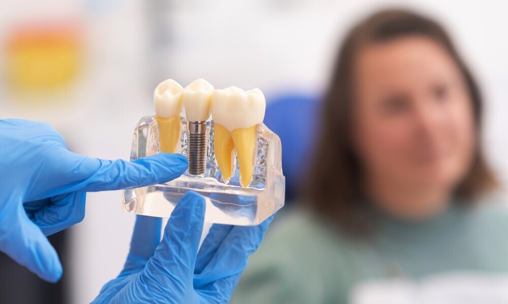 Demystifying Dental Implants: A Comprehensive Guide to Transforming Your Smile