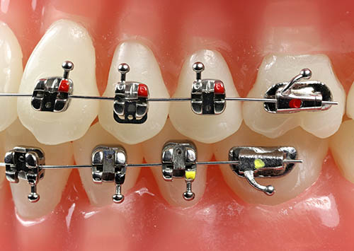 Orthodontics Treatment